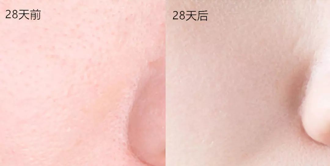 28天解决了所有皮肤问题，你猜我做了些什么？