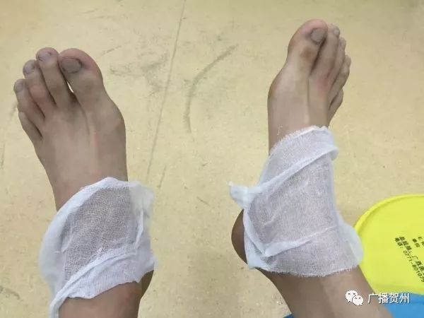 广西虫咬伤人,广西腿被虫咬伤