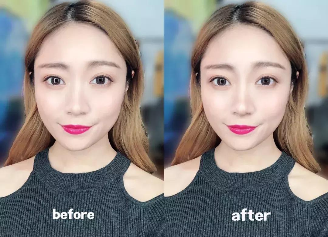 蒜头鼻怎么改变鼻型,蒜头鼻厚鼻翼怎么矫正