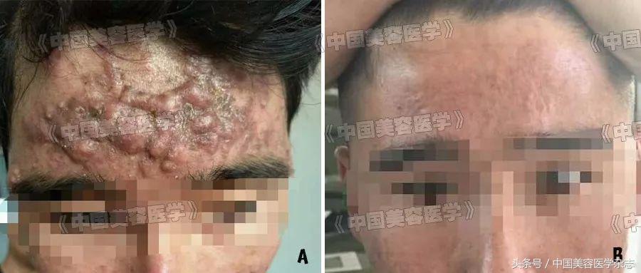 面部痤疮有什么危害,严重性痤疮要注意什么