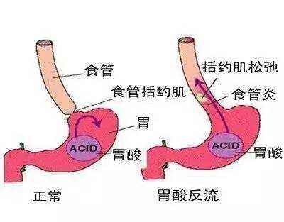 胃酸，反酸，胃胀该怎么吃饭？注意什么？