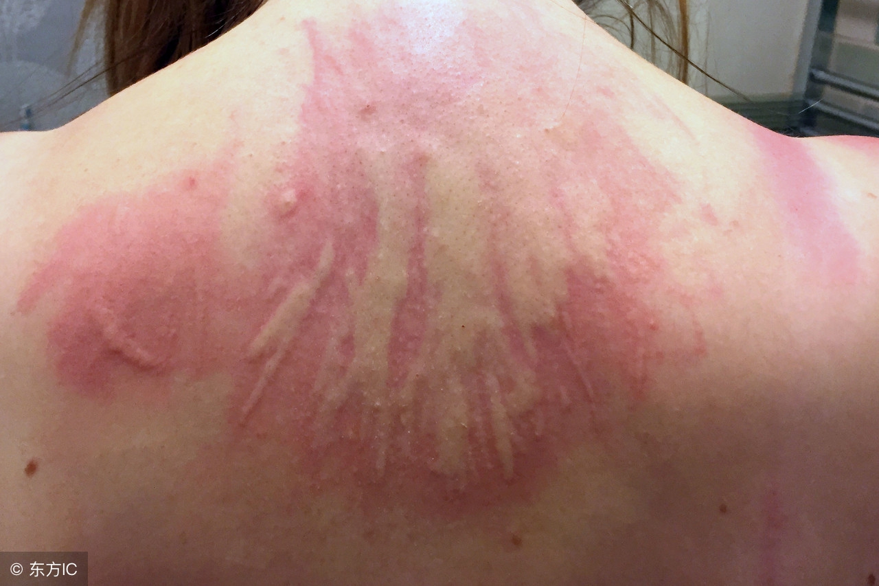 皮肤麻疹的症状和注意事项,皮肤风团荨麻疹怎么治