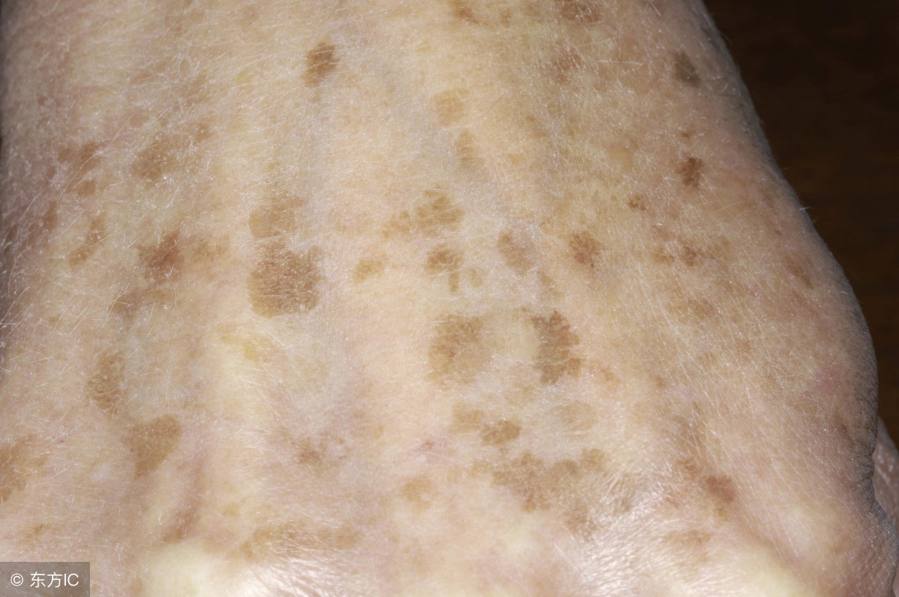 老年斑的预防和去除的方法,怎么预防老年斑的最有效的方法