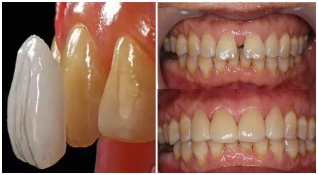 门牙牙缝大矫正最快的方法,门牙牙缝大怎么修复不伤牙齿