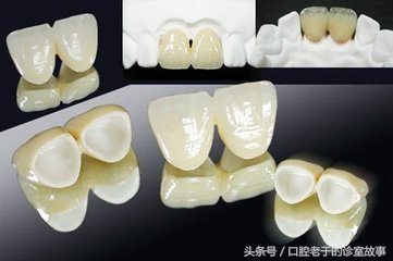 烤瓷冠与全瓷冠价格哪个贵,烤瓷冠多少钱一颗