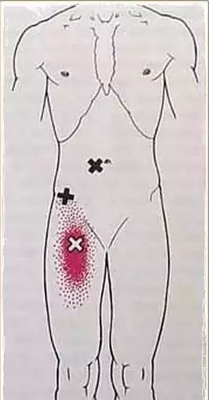 锻炼腰部肌肉时盆骨后侧不舒服,锻炼竖脊肌改善骨盆前倾