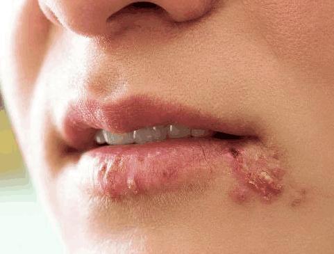 23岁小伙起红疹被误诊6年查出癌症,23岁小伙起红疹被误诊6年