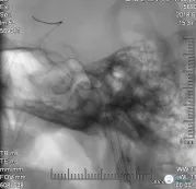 颈动脉闭塞介入治疗的风险,慢性动脉闭塞症病例