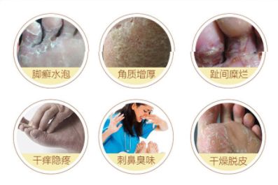 告别“香港脚”，需要用马油！一天涂抹一次，保证24小时清爽！