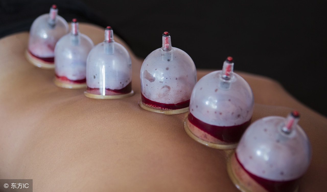 拔罐排毒对身体元气损伤大吗,拔罐真的能排毒吗