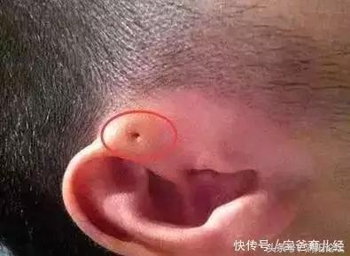 宝宝刚出生耳朵上长了个肉球,新生儿耳朵旁边有个小孔父母没有