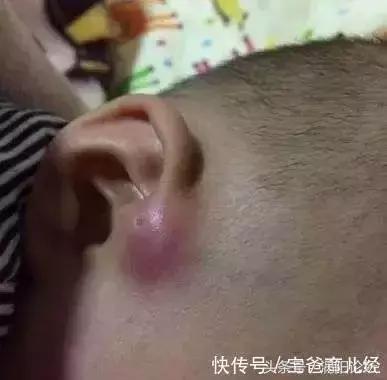 宝宝刚出生耳朵上长了个肉球,新生儿耳朵旁边有个小孔父母没有
