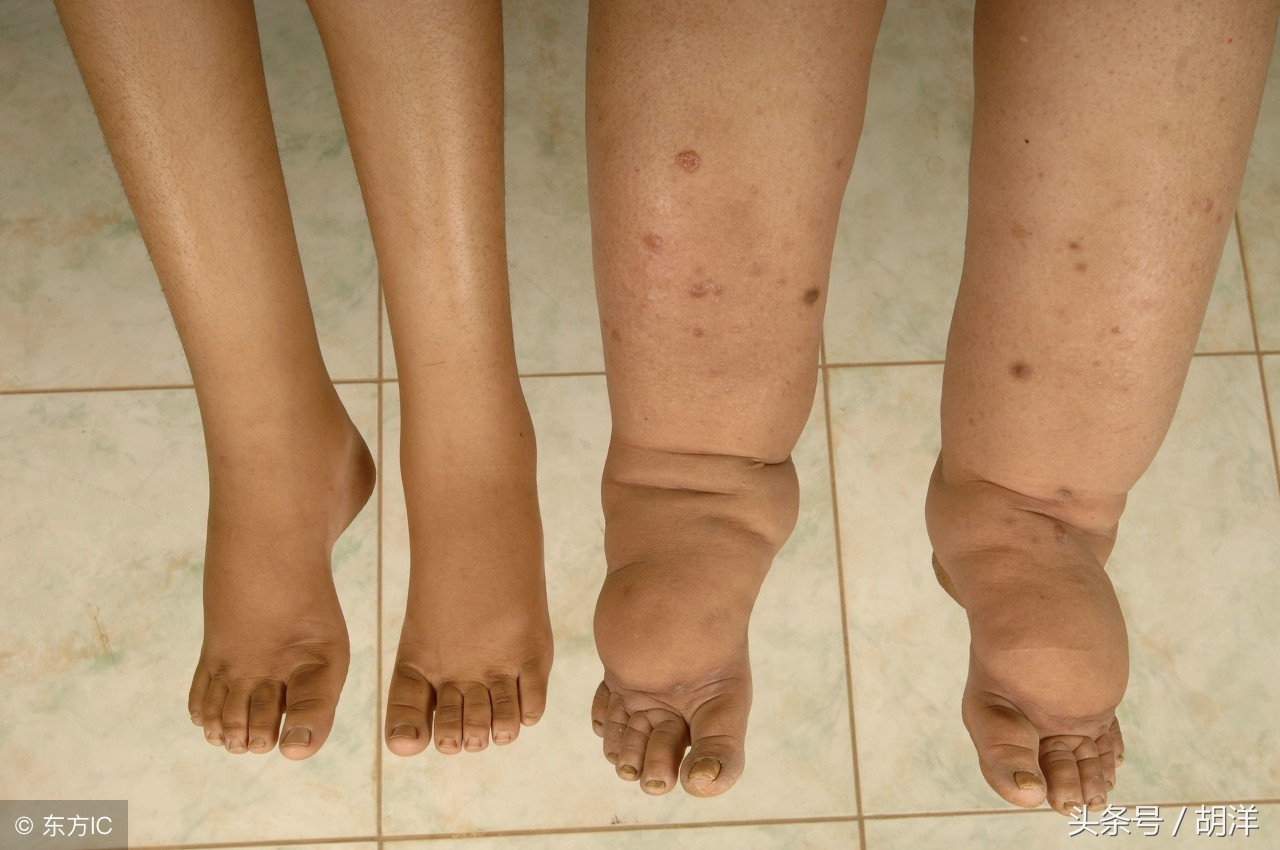 莫名脚肿了有后续吗,莫名其妙的脚肿查不出什么原因