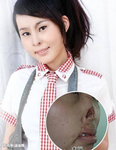 山东女孩被老鼠咬掉鼻子,被老鼠咬掉的无鼻女孩