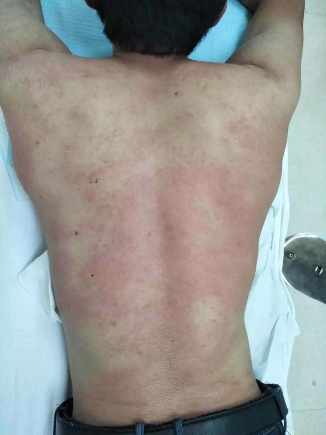 被蜜蜂蛰过不得癌症是真的吗,被6只蜜蜂蛰了会怎么样