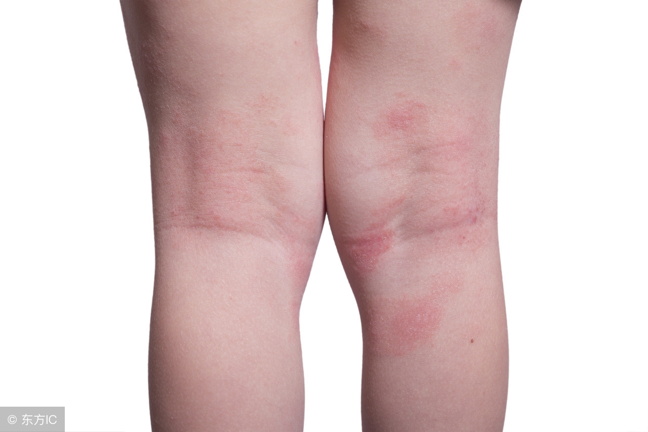 湿疹皮炎反复复发怎么治,名医讲堂湿疹反复复发怎么办