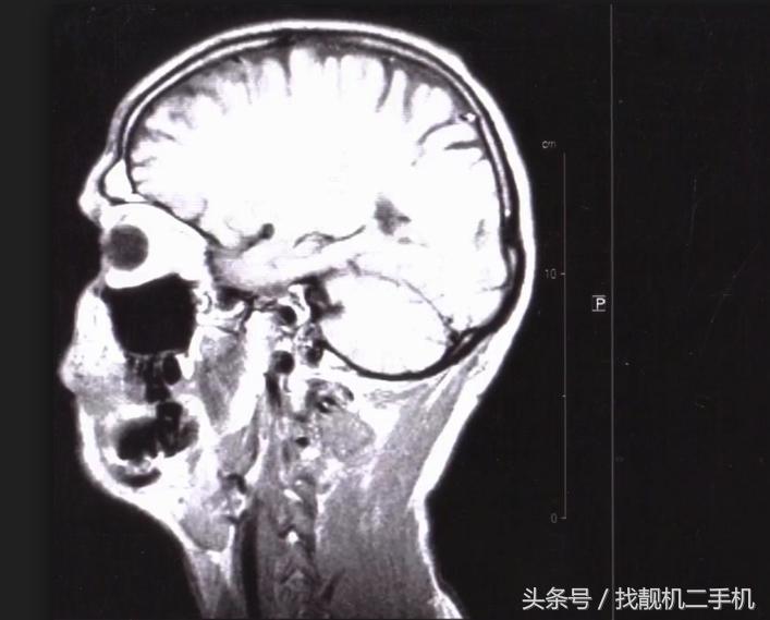如果误吸入汞如何补救,汞不小心洒到地上处理方法