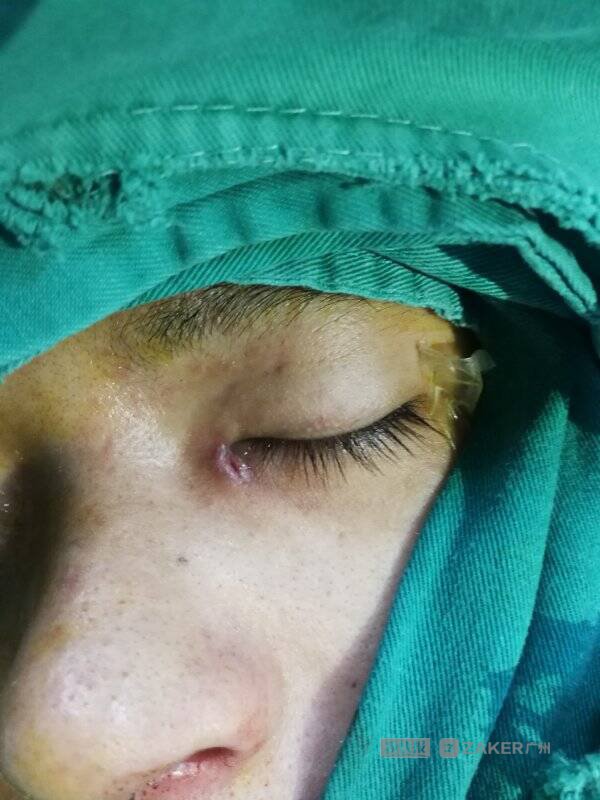 眼睛红肿化脓挡住瞳孔,眼睛进异物发炎流脓