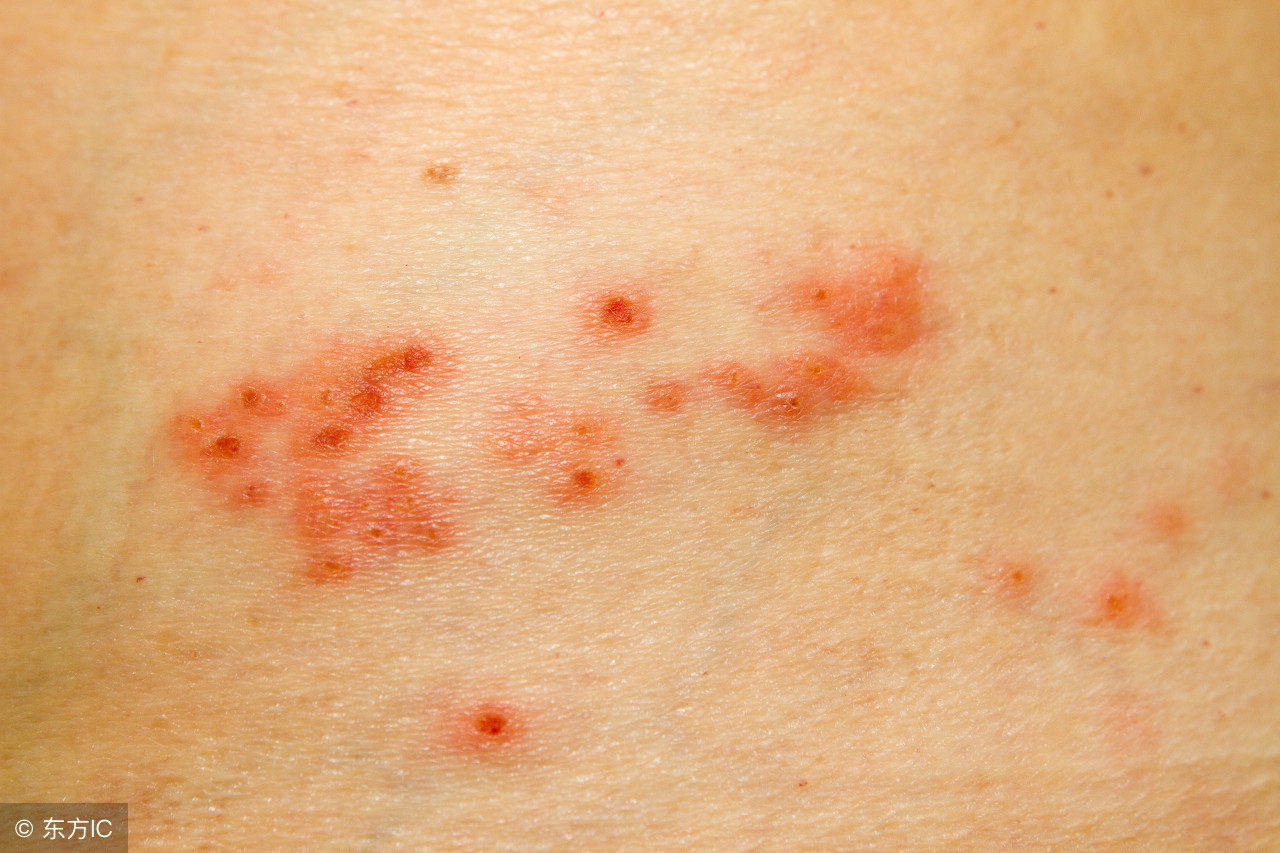 生殖器疱疹潜伏期一般有多少时间,生殖器疱疹目前潜伏期最长多久