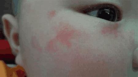 新生儿常见皮肤病大全,值得收藏