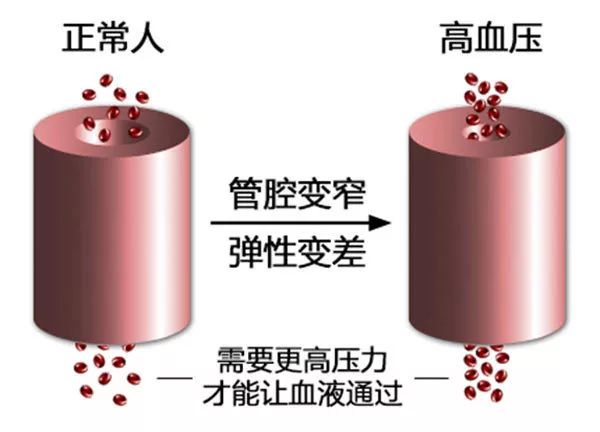 高血压怎么样才能发生猝死,高血压隐形杀手