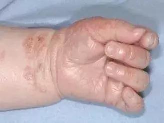 宝宝身上一大片的包是怎么回事,宝宝身上好多片包