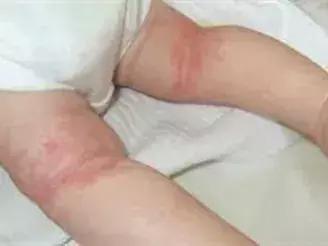 宝宝长小疹子后溃烂,宝宝的红疹子溃烂了