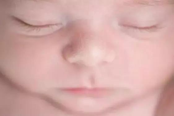 六个月宝宝湿疹皮肤破溃,宝宝起红疹破皮水泡
