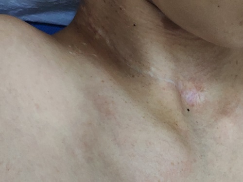 重度漏斗胸手术怎么做,胸廓畸形导致缺氧能做手术吗