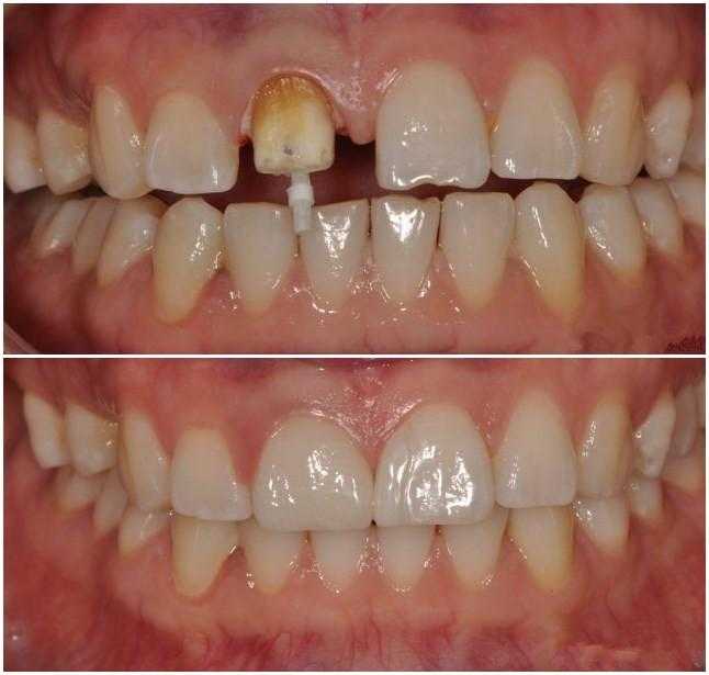 镶牙和种牙的区别种植牙的危害,种植牙的利与弊能镶牙就不要种牙