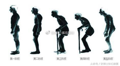 运动康复科普强直性脊柱炎,强直性脊柱炎腰部锻炼康复方法