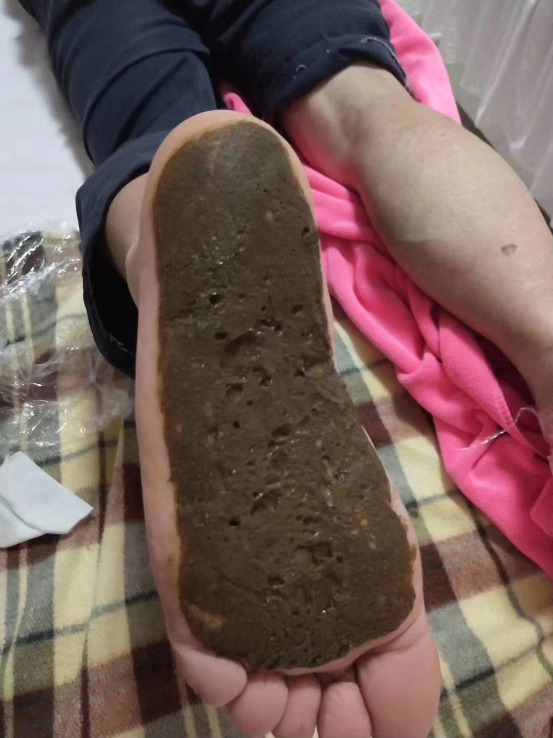 骨刺和足底筋膜炎是不是一回事,跟骨骨刺会导致足底筋膜炎吗