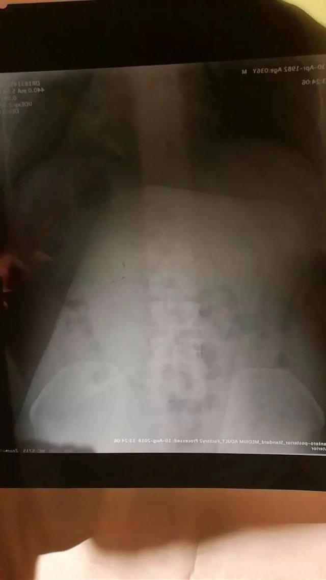 飞机餐吃出蟑螂怎么赔偿,飞机餐吃了食物中毒怎么索赔