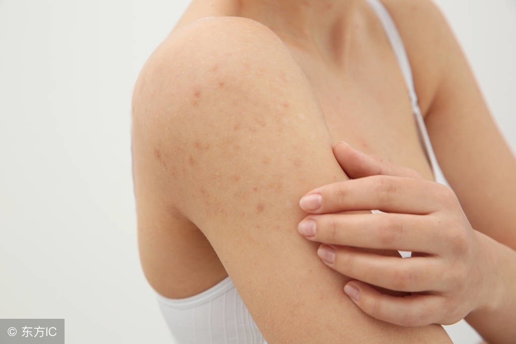 皮疹与湿疹区别在哪里？皮疹的饮食禁忌