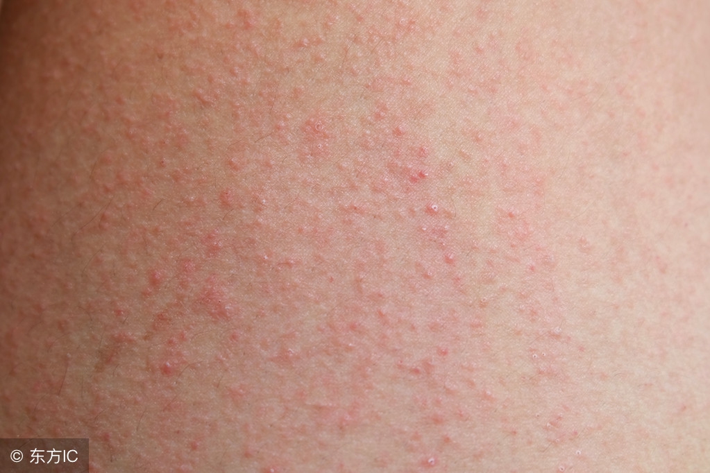 皮疹和湿疹有什么区别,皮疹和湿疹是怎么引起的