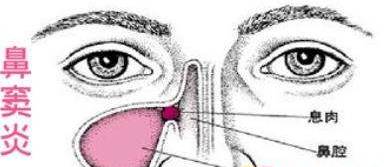 鼻窦炎久治不愈怎么办,鼻窦炎长时间不治疗