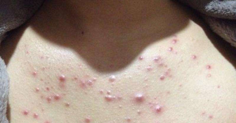 注意了身上长这5种痣特容易癌变,痣出现哪些变化是恶变的征兆