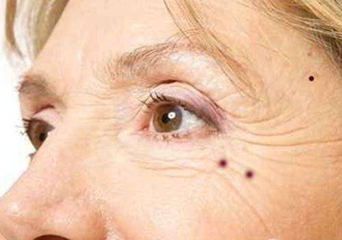 注意了身上长这5种痣特容易癌变,痣出现哪些变化是恶变的征兆