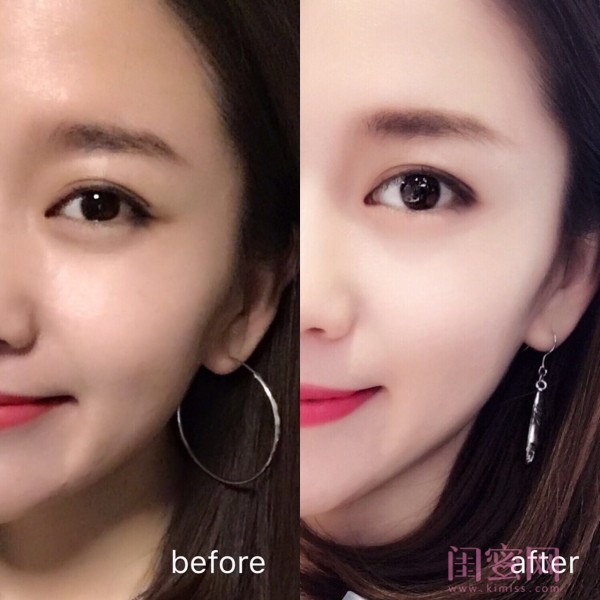 有法令纹很显老怎么办,法令纹木偶纹哪个显老