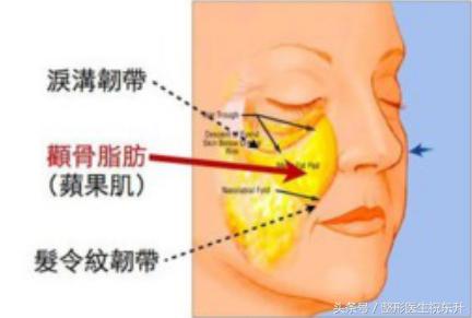 不埋线面部线雕全过程,线雕提拉术知识大全
