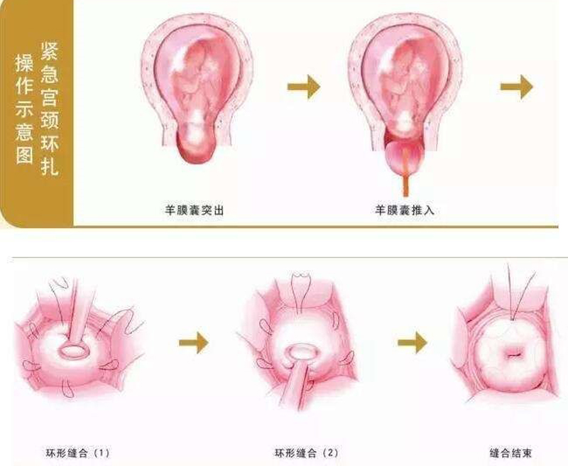 妇幼保健院三胞胎,妇幼保健院4胞胎