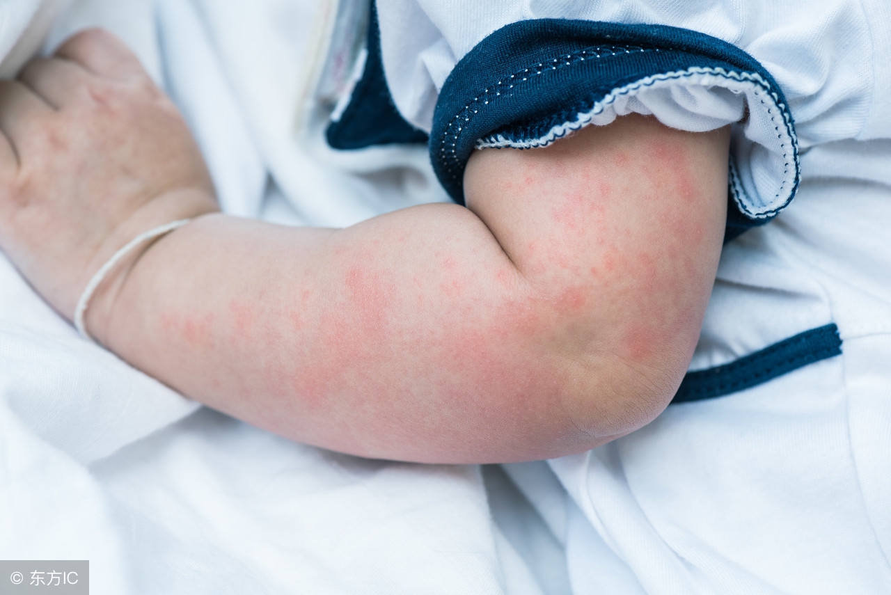 孩子麻疹反复是怎么回事,宝宝慢性荨麻疹多久才自愈