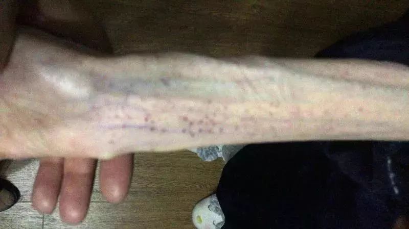 21岁女孩自杀式减肥只剩50斤，照片不忍直视