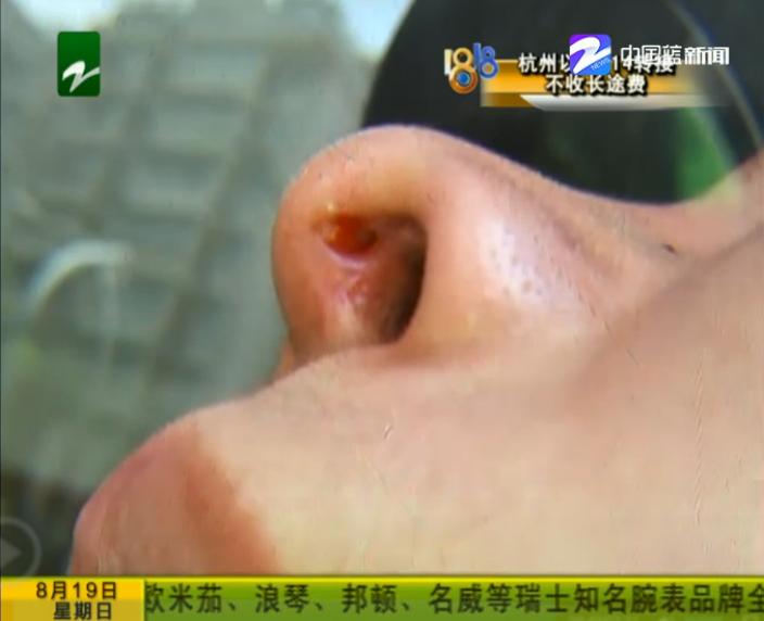 鼻子整毁了可以让医院赔偿吗,鼻子整形后发炎怎么办