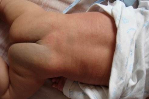 幼儿急疹治疗方法及护理,幼儿急疹需要注意的事项