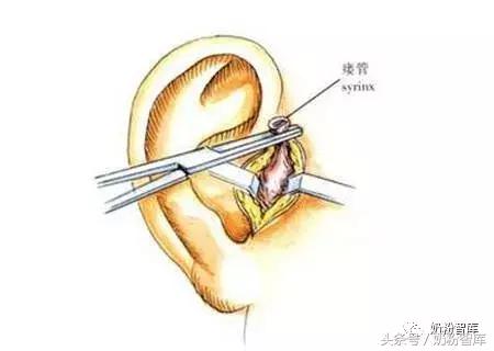 宝宝耳朵里小孔,宝宝耳朵上有个小孔怎么处理