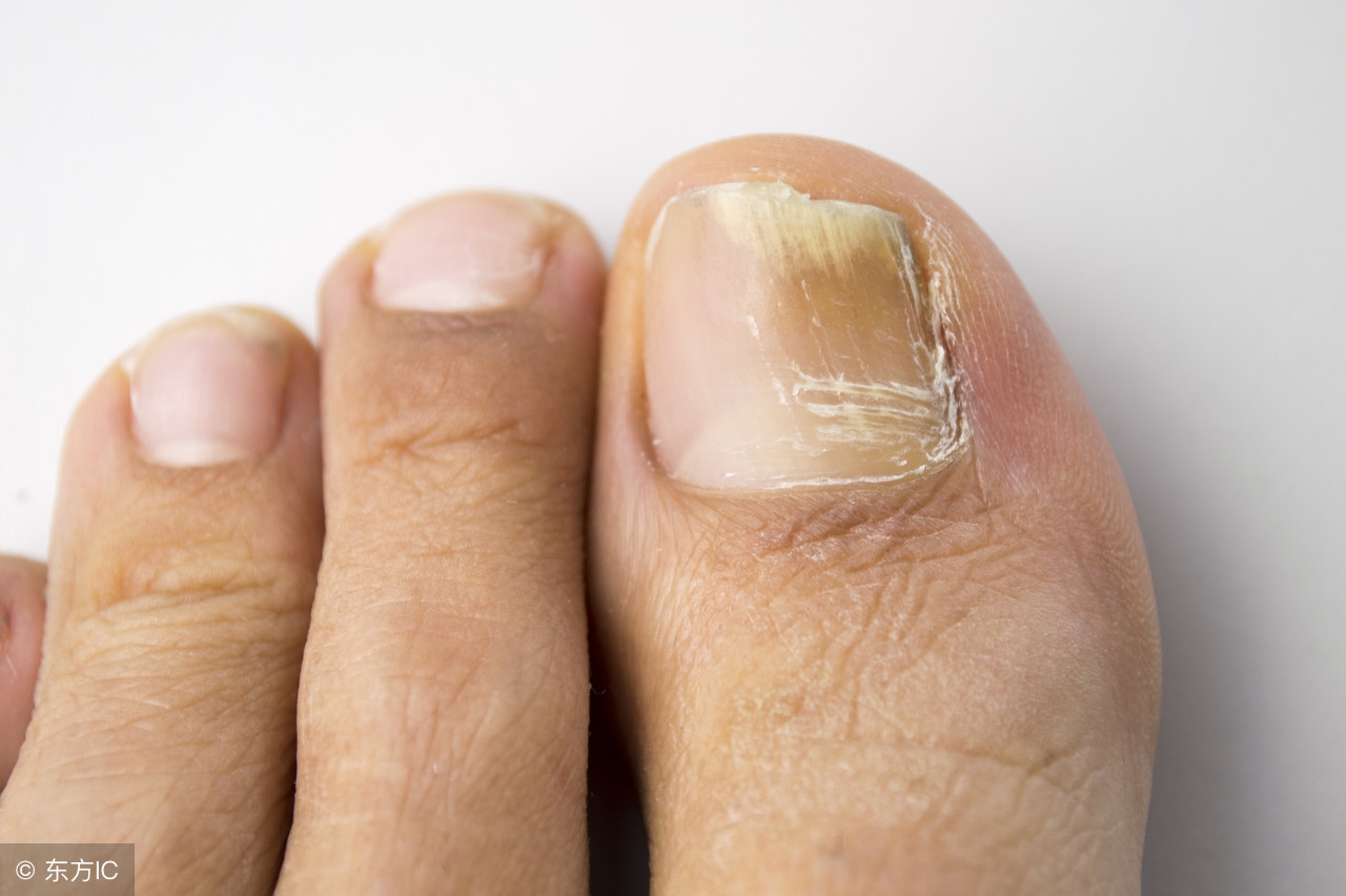 灰指甲怎么看，灰指甲这一点一定要注意，不然会引起严重的后果