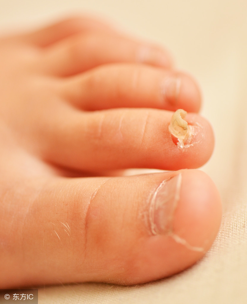 得了灰指甲有什么要注意的,灰指甲怎么看严重程度