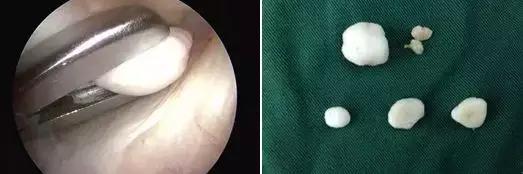 膝关节有轻微卡住的感觉怎么办,膝关节像被卡住疼痛怎么办