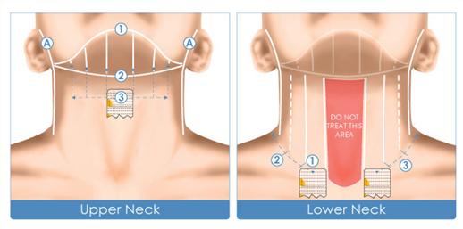 超声刀后注意什么,超声刀后什么不能吃